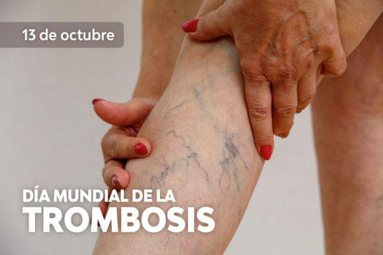 TROMBOSIS
