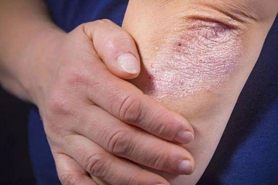 83446-el-viernes-se-hara-deteccion-de-enfermedad-psoriasica-en-el-hospital-san-bernardo