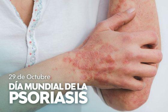 78845-la-psoriasis-no-es-contagiosa-y-se-puede-controlar-con-tratamiento-medico