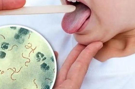 92481-salud-informa-la-situacion-epidemiologica-de-streptococcus-pyogenes-20231023150517
