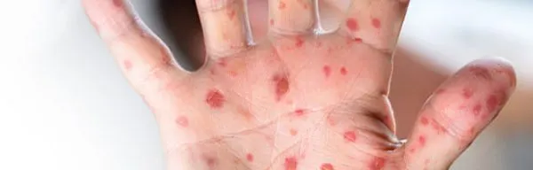 2019_12_27_sarampion_mano2-600x192