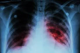tuberculosis diagnóstico
