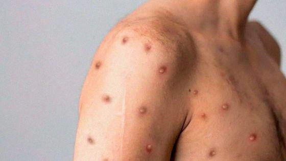 97252-hasta-el-momento-no-se-notificaron-casos-sospechosos-de-viruela-simica-en-salta