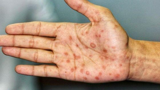 96073-la-sifilis-continua-siendo-un-problema-de-salud-publica-a-nivel-mundial