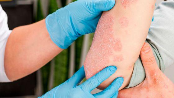 97387-el-81-de-las-personas-que-acudieron-a-la-deteccion-de-psoriasis-dieron-resultado-positivo