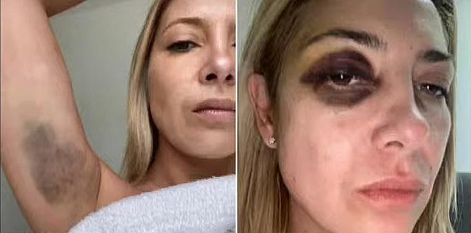 Fotos-de-fabiola-yanez-golpeada-con-moretones