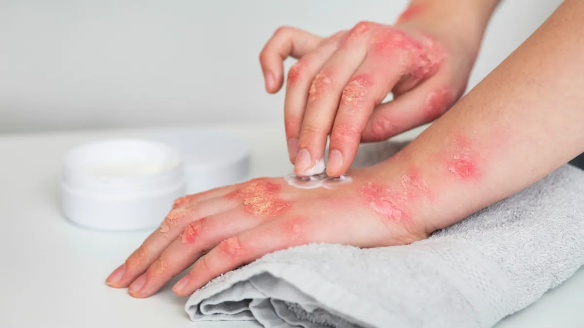 Una-mujer-con-psoriasis-en-las-manos-se-aplica-crema